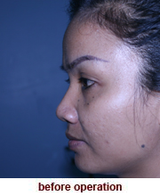 plastic_surgery_augmentation_rhinoplasty